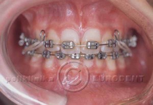 ortodoncija_3 (2)